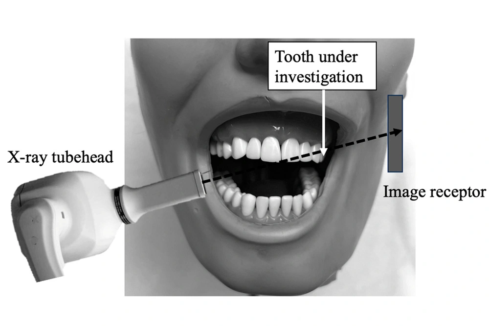آشنایی با تصاویر پری اپیکال 