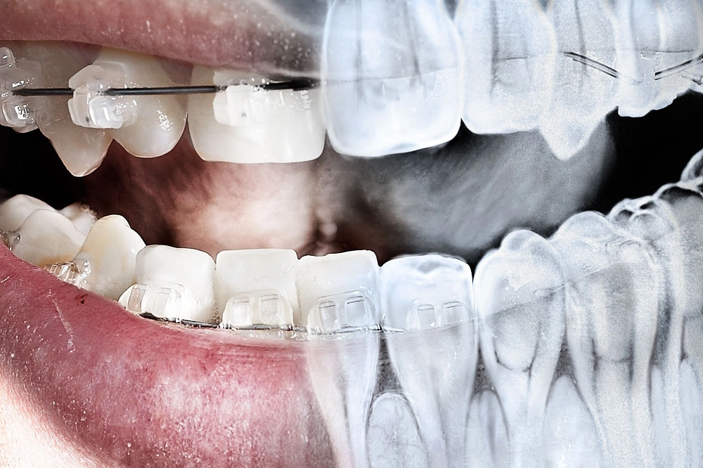 مراحل بایت وینگ گلشهر