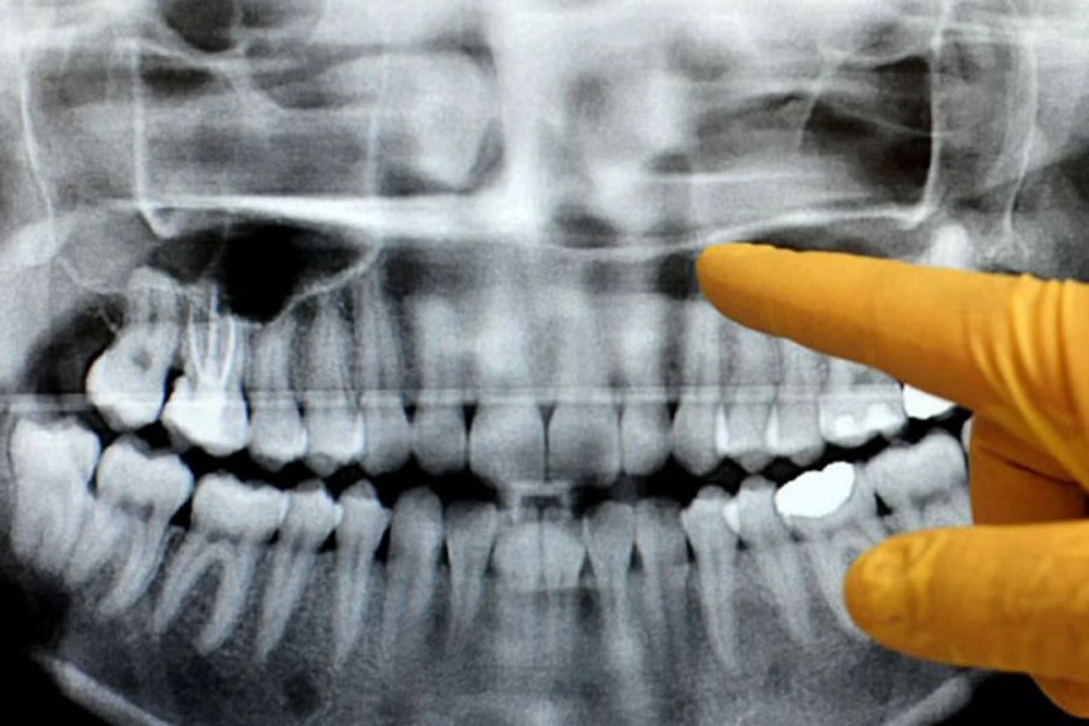 گرافی بایت وینگ کرج در بررسی تحلیل استخوانی دندان‌ها