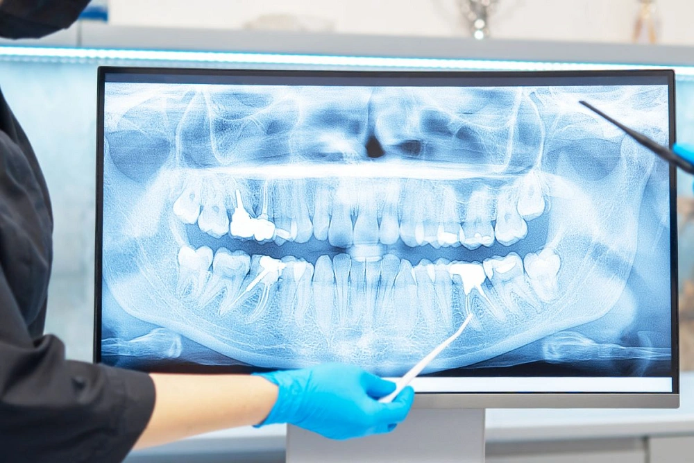 مزایای رادیوگرافی پری اپیکال چیست