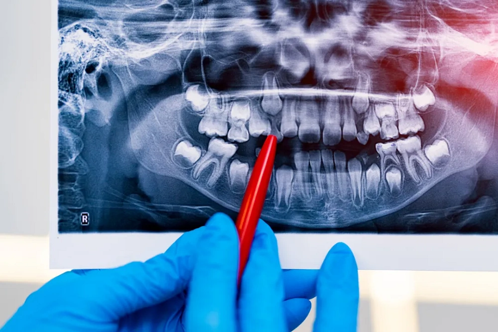 پری اپیکال در دندانپزشکی چیست؟