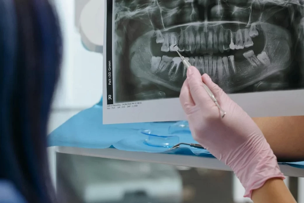 رادیوگرافی دندان نمای پری اپیکال: راهنمای کامل تشخیص